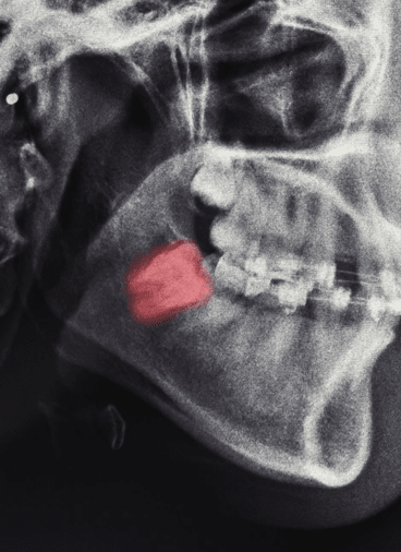 Treatment - hampsteaddental